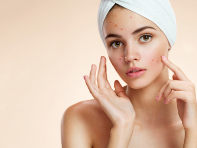 臉上長(zhǎng)痘痘要忌口哪些食物 長(zhǎng)痘的飲食禁忌