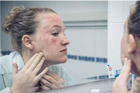 皮膚過敏紅癢怎么辦，過敏皮膚的日常護理五大方法