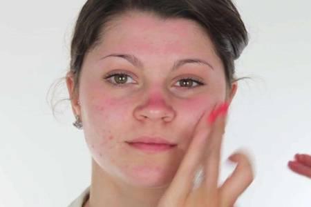 臉上長痘痘如何消除，六個小妙招祛痘簡單快捷