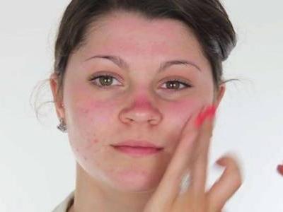 臉上長(zhǎng)痘痘如何消除，六個(gè)小妙招祛痘簡(jiǎn)單快捷