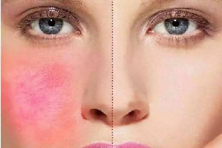 皮膚過敏癥怎么治除根，女生臉上紅腫過敏的緩解方法
