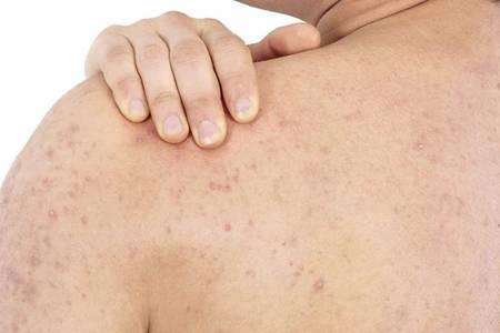 雞皮膚的四大形成原因，如何消除雞皮膚光滑肌膚