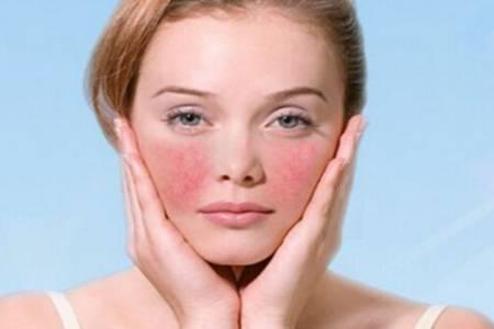 激素臉初期癥狀圖片大全 嚴重的激素臉紅癢用什么去除