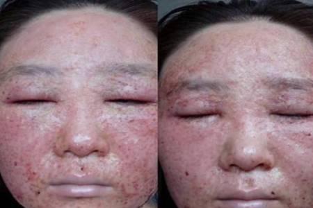激素臉初期癥狀圖片大全 嚴重的激素臉紅癢用什么去除