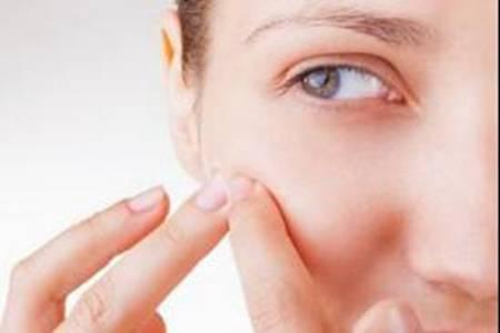 閉口粉刺是什么怎么去除  5招讓你輕松去除閉口痘痘