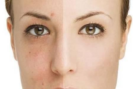 閉口粉刺是什么怎么去除  5招讓你輕松去除閉口痘痘