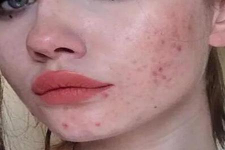 青春痘怎么快速消除？做好這5點或許好得快改善皮膚