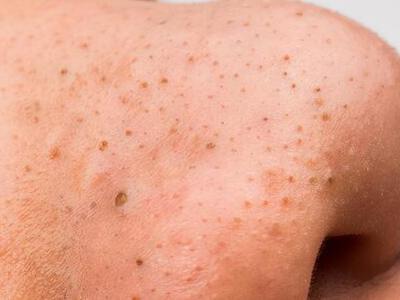 怎么去黑頭？這五個方法幫助你消滅它們