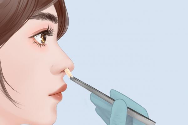 隆鼻手術的風險大嗎