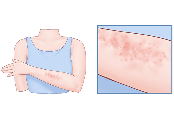 化妝品過敏的癥狀是什么?