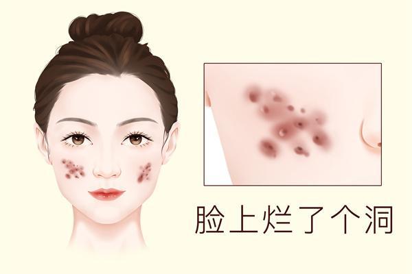 怎么去掉臉上的青春痘