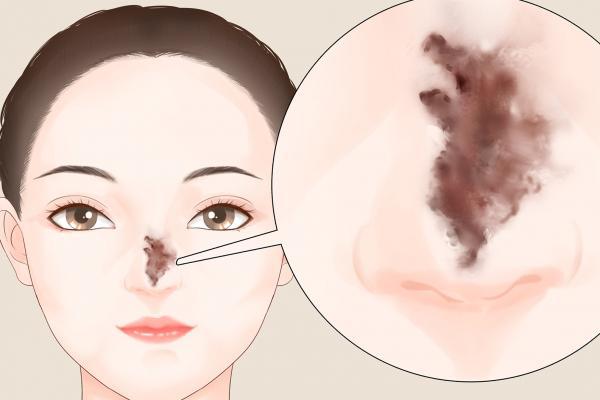 隆鼻可以只隆鼻梁不隆鼻尖嗎