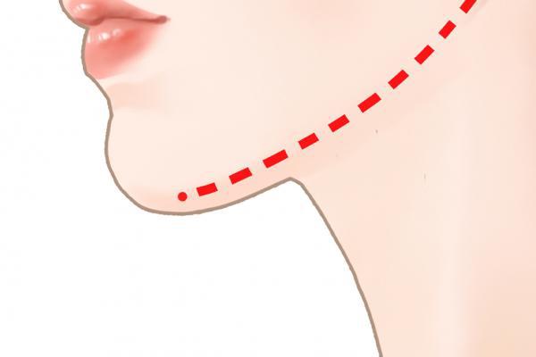 去掉下頜角有什么方法