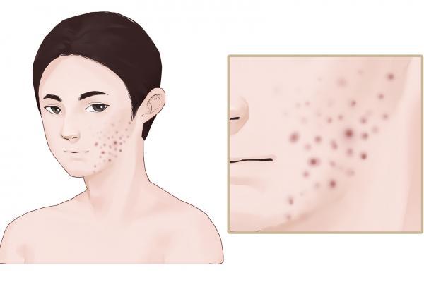 什么是激素臉,怎么造成的