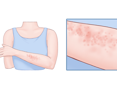 化妝品過(guò)敏的癥狀是什么?