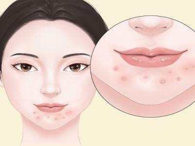 粉刺是怎么形成的