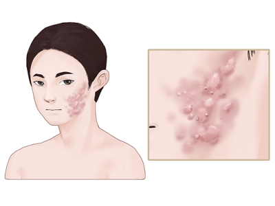 臉上的痘坑怎么修復