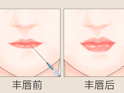 玻尿酸多少錢一針