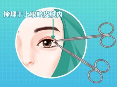 雙眼皮做手術(shù)一般價錢