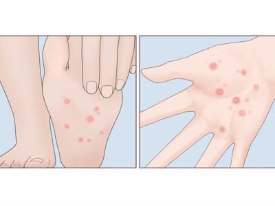 身上長紅痣是怎么回事