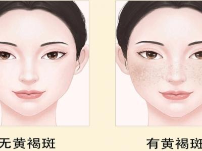 激光治療黃褐斑有用嗎