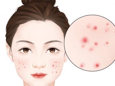 怎么去掉臉上的青春痘