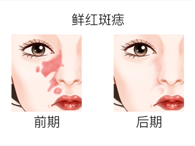 激光去痣后注意事項