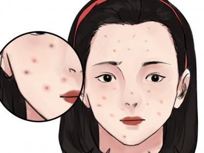 怎樣祛除痘印