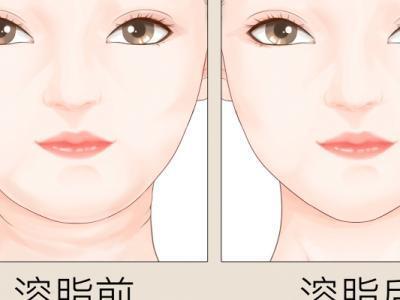 面部溶脂針副作用