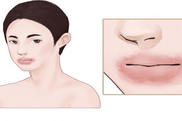 臉部過敏發紅發癢怎么辦