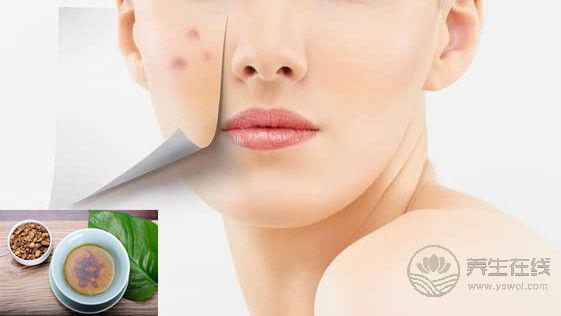 秋燥上火“痘痘”長，去痘要分虛實治