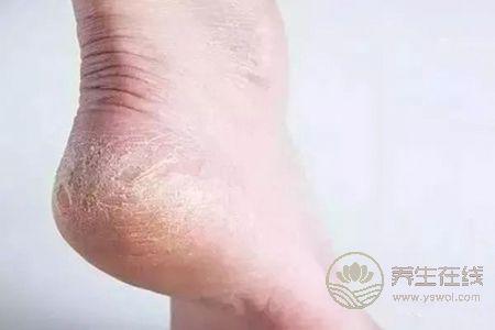 冬天腳跟干裂該怎么辦?