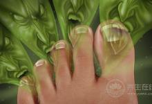 夏季腳臭如何制理除腳臭最快的好方法