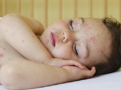 怎么調(diào)理花粉過(guò)敏體質(zhì) 喝蜂蜜防過(guò)敏7個(gè)方法在家治過(guò)敏