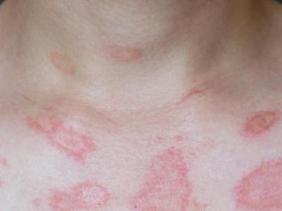 春季花粉過敏怎么預防 孕媽媽把握三原則可預防花粉過敏