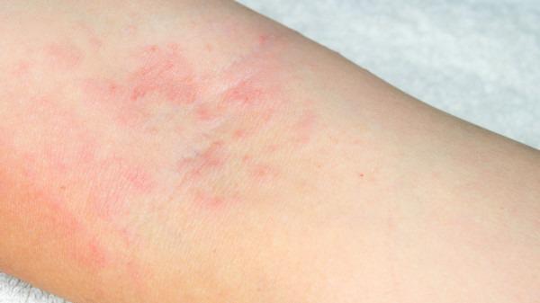 冬天身上癢是怎么回事？看這3原因對不對