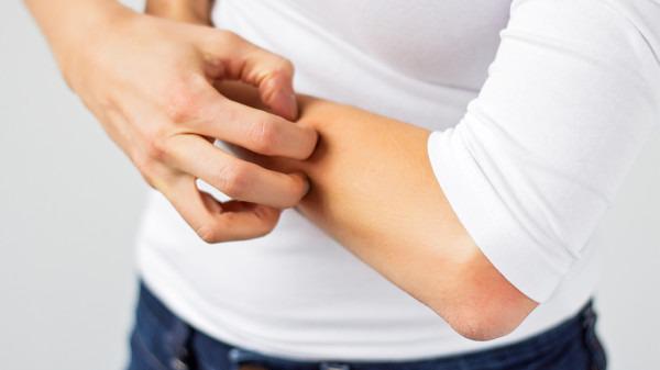 冬天皮膚瘙癢是血燥? 需要內外調理-易網健康<a href=http://m.henggaotouzi.com/jkys/ target=_blank class=infotextkey>養生</a>網 冬天皮膚瘙癢是血燥? 需要內外調理