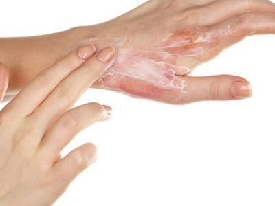 冬天手長凍瘡了怎么辦？注意預防