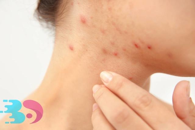 水土不服過敏多久能好，原來它還和身體素質(zhì)有關(guān)!