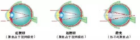 關于散光,這些你都了解嗎? 關于散光,這些你都了解嗎?