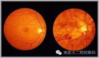 高血壓病人易出現(xiàn)眼底出血