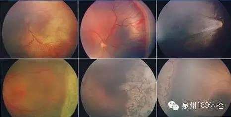 忽視糖尿病治療會(huì)致雙目失明？