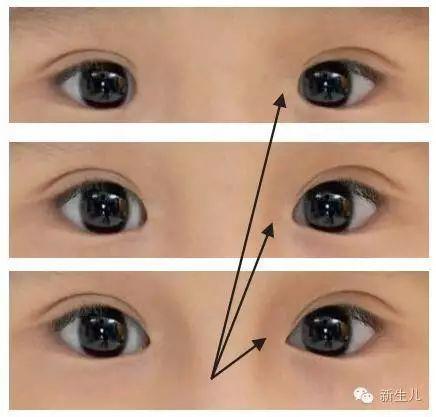 怎樣區(qū)別你的寶寶是否有斜視眼？