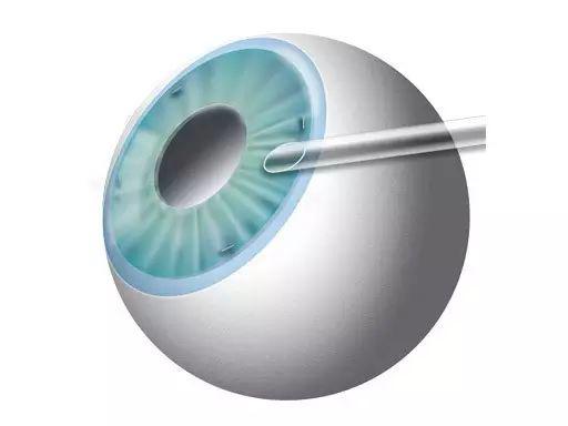 高度近視朋友需要預防六種常見并發癥