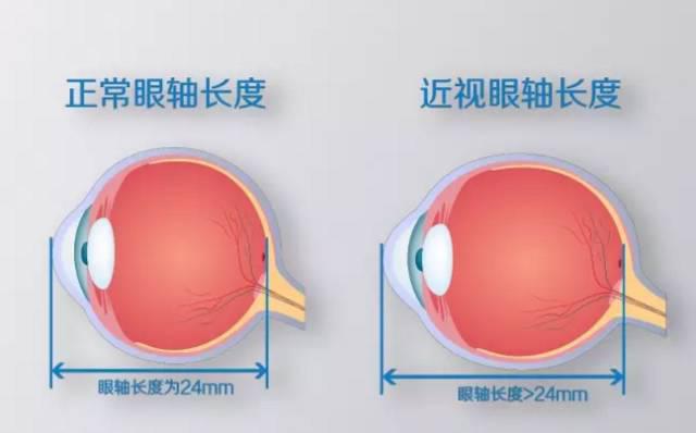 近視不可怕，度數越來越深才可怕