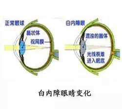 白內障初期的六大警報，五類高發(fā)人群