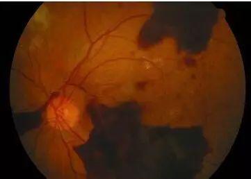 糖尿病會(huì)導(dǎo)致眼睛失明，視力模糊是前期征兆！