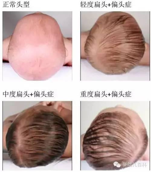 孩子的頭型與睡枕頭有關系嗎? 孩子的頭型與睡枕頭有關系嗎?