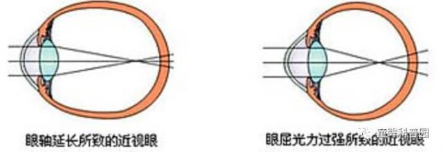 你不得不知的兒童近視幾大問(wèn)題 你不得不知的兒童近視幾大問(wèn)題