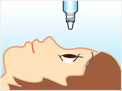 近視手術要多久才能恢復視力？恢復期間會不會影響正常生活？